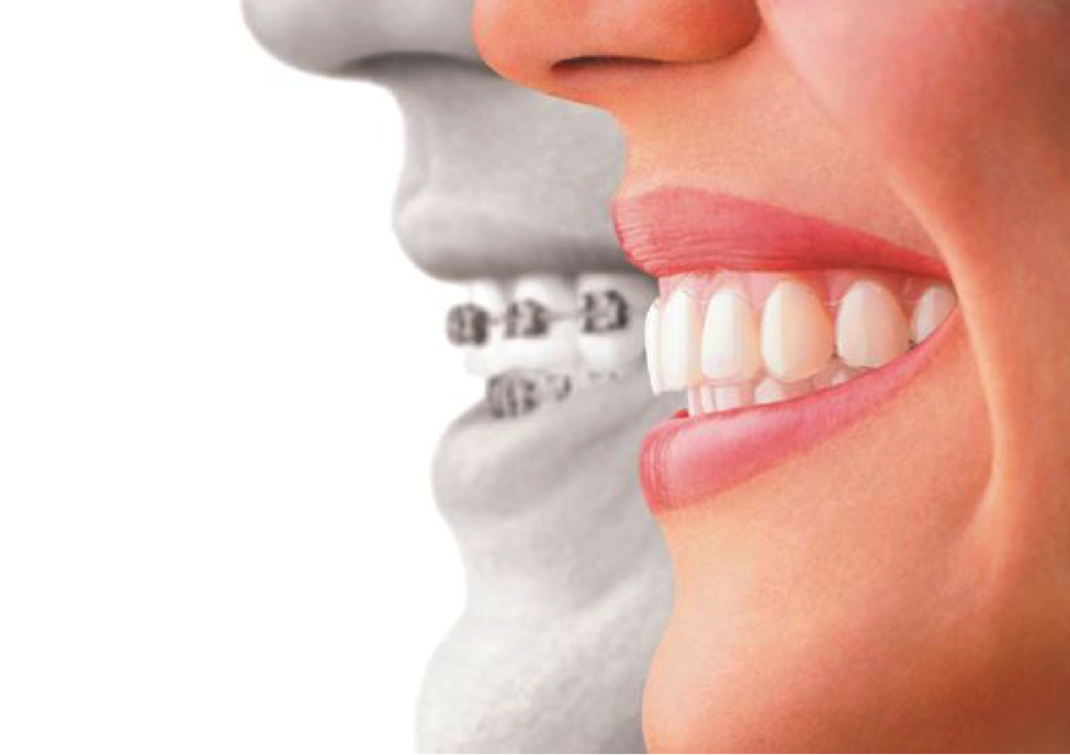 invisalign The difference invisalign can make.