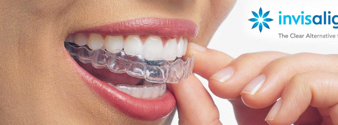 Invisalign clear aligners, the clear alternative to braces.