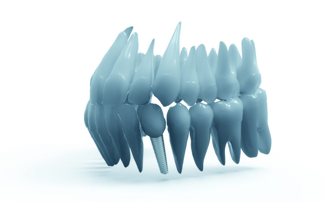 Dental implants can blend seamlessly with your teeth.